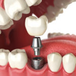 implanty zębowe