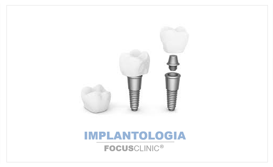 7 FAKTÓW O IMPLANTACH