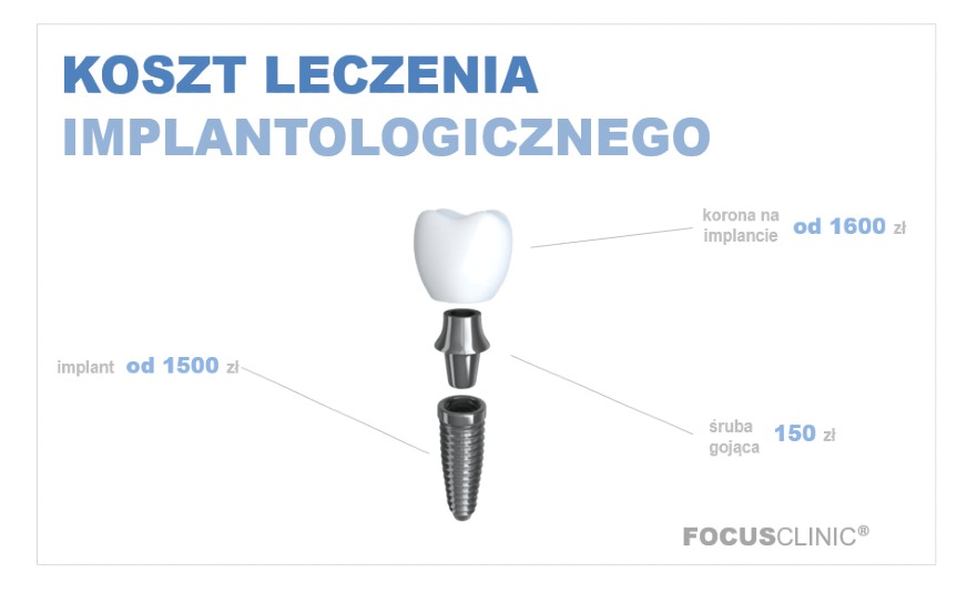 ILE KOSZTUJE IMPLANT?
