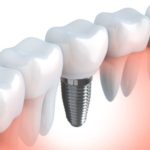 Co to jest implant dentystyczny?