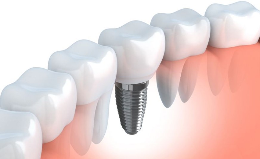 Co to jest implant dentystyczny?