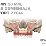 IMPLANTY ZYGOMATYCZNE – czym są i kiedy się je stosuje?