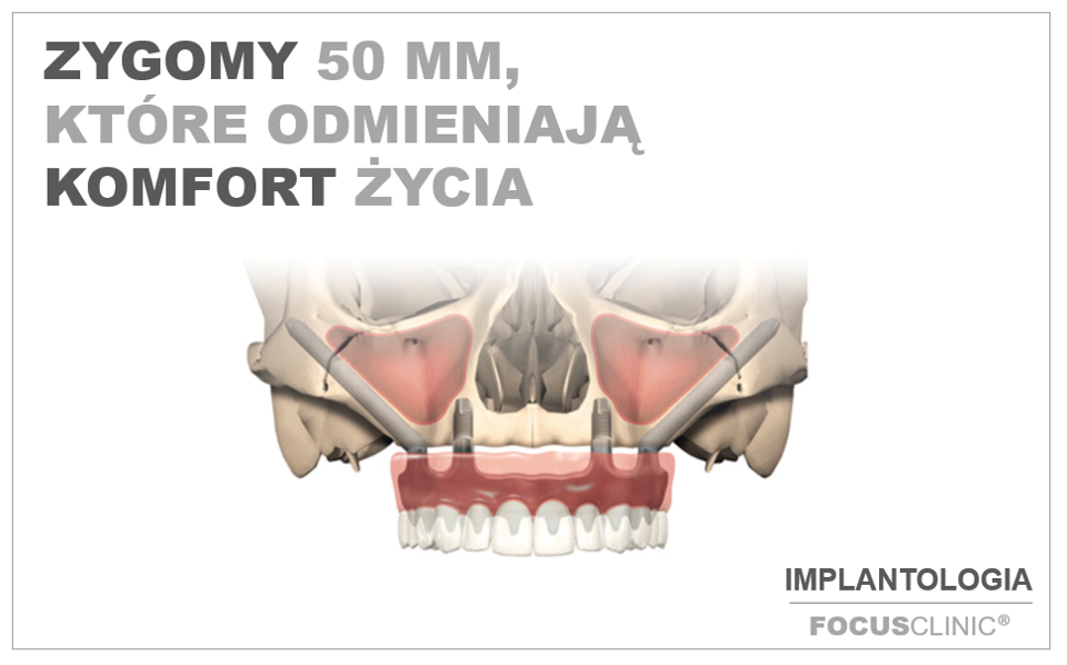 IMPLANTY ZYGOMATYCZNE – czym są i kiedy się je stosuje?