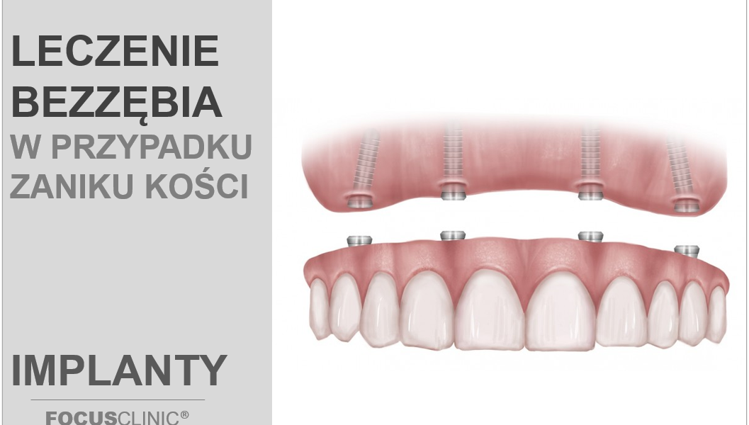 Leczenie bezzębia przy zanikach kostnych