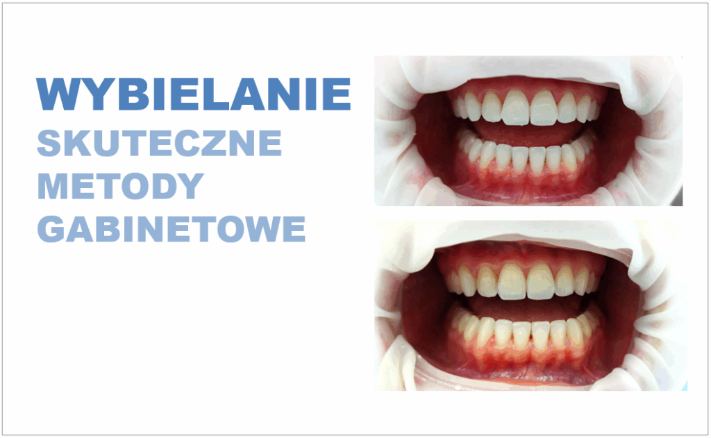 Wybielanie zębów – bezpieczne i skuteczne metody