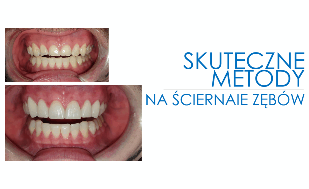 Ścieranie zębów - jak sobie z nim poradzić?