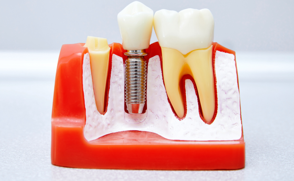 pielęgnacja implantów zębowych