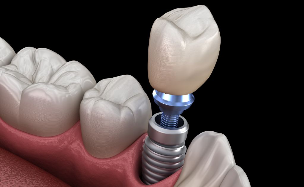 wady protezy na implantach