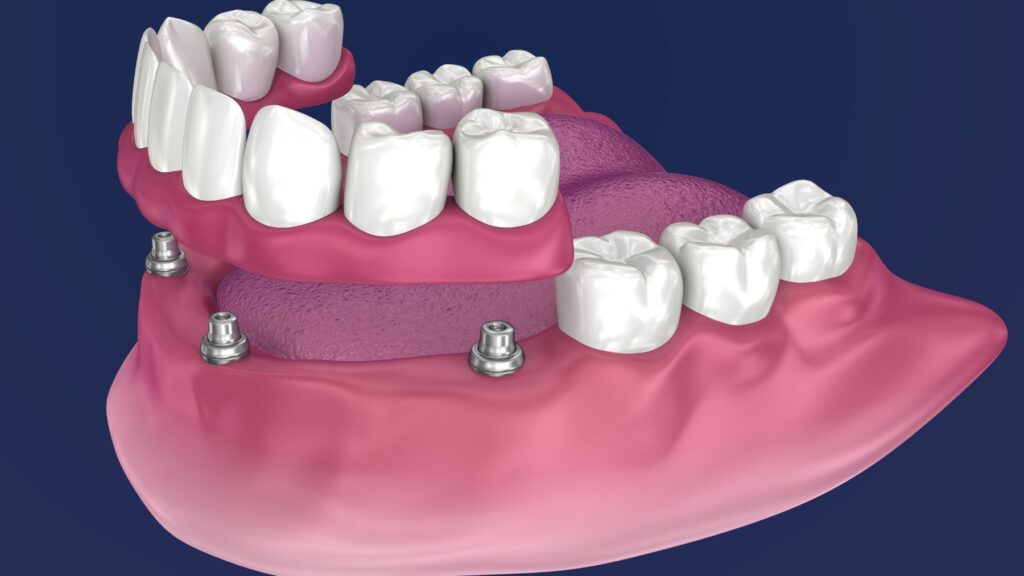 Proteza overdenture