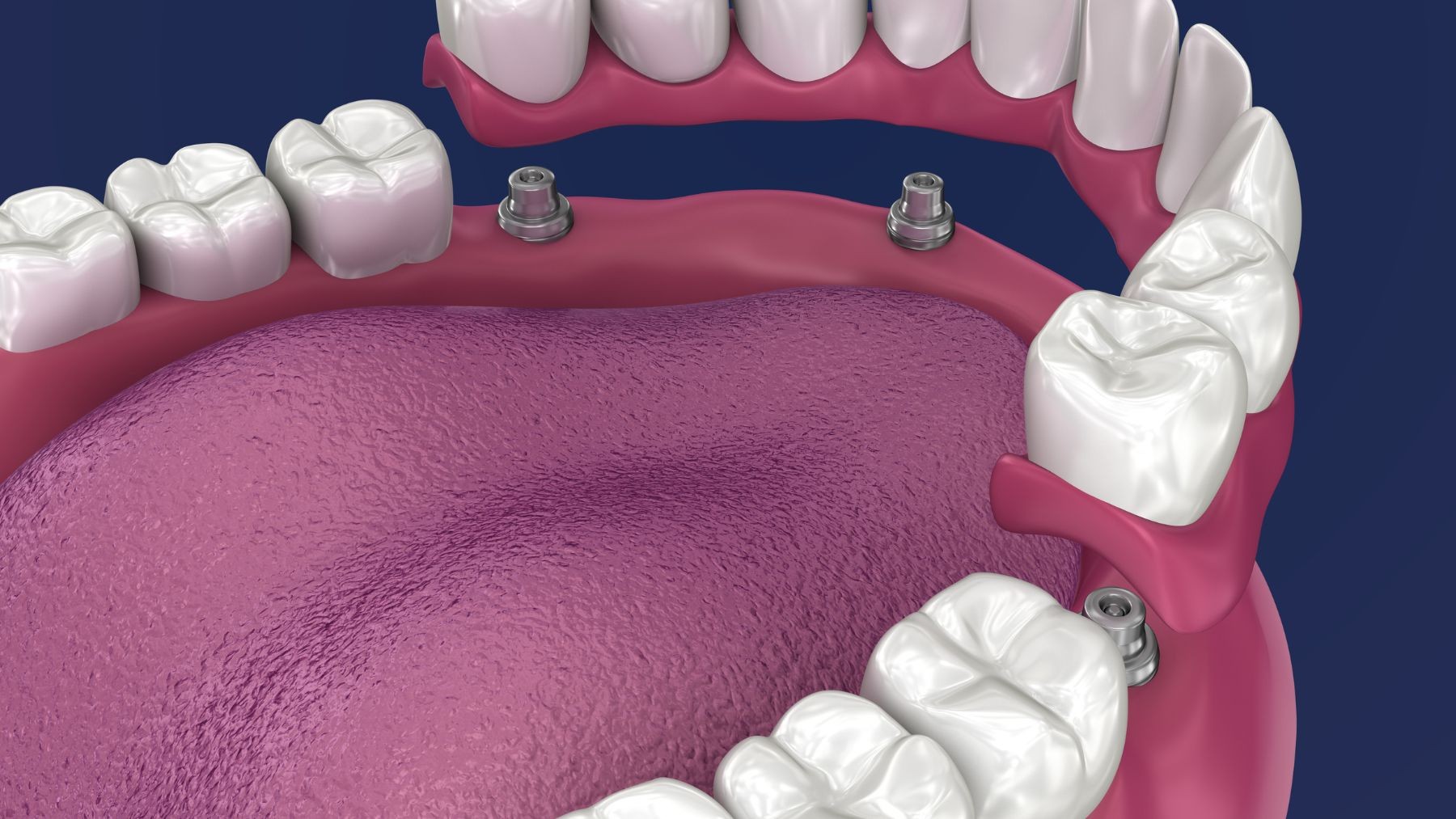 Proteza overdenture co to
