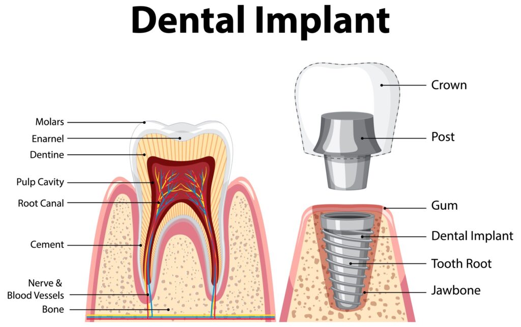 implant zęba budowa
